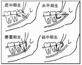 阻生智齿 阻生智齿